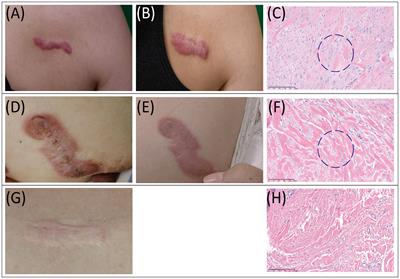 Revisiting roles of mast cells and neural cells in keloid: exploring their connection to disease activity